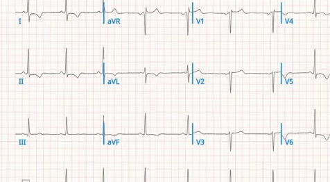 美国克利夫兰诊所：用AI解读心电图，竟能发现心脏“变胖”