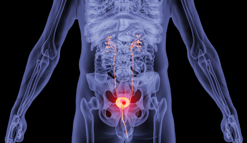 92%患者肿瘤完全消失！膀胱癌新药NDV-01带来突破性疗效