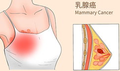 70%的中国女性都有“高密度乳腺”？这不是身体好，而是要更警惕