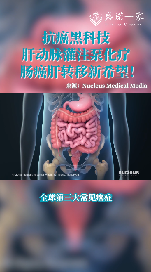 国际医疗前沿：肝动脉灌注泵化疗——结直肠癌肝转移患者新希望！