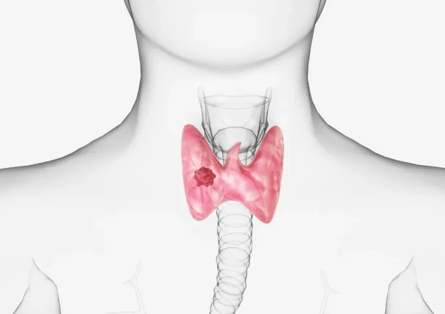 你了解甲状腺健康吗？症状、检查和生活小贴士全解析