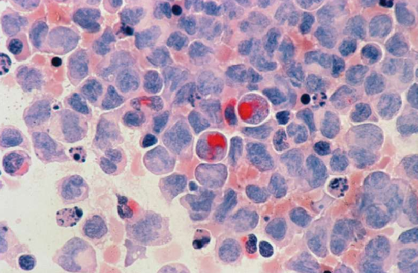 乳腺癌药物竟能帮助白血病治疗？意外组合有望解决棘手耐药问题！