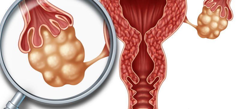 确诊即晚期、腹水严重、肿标超正常值几十倍的她,如何成功逆天改命,实现无癌?