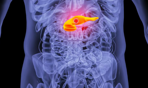 美国医学前沿：新型T细胞疗法攻克“胰腺癌”？两名胰腺癌患者实现66个月无复发