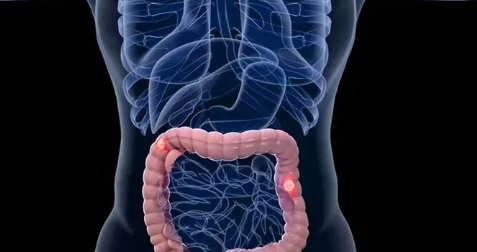 2026消化道肿瘤大会：FOLFIRI组合方案使64.4%转移性肠癌患者肿瘤缩小或消失！