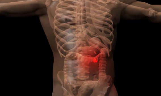 转移性结直肠癌新疗法有望今年12月前获批：Zanzalintinib联合Atezolizumab，显著延长生存期