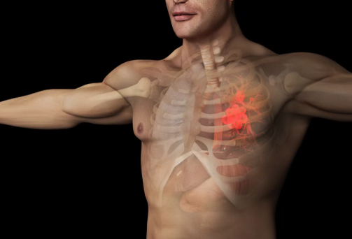 吸入式免疫疗法KB707在晚期肺癌中疗效积极，美国FDA授予其再生医学先进疗法资格