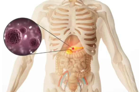 美国妙佑医疗国际(原梅奥诊所)1400例研究颠覆指南：这类胰腺癌，明确应“先化疗再手术”！