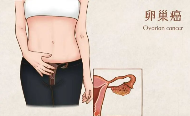 美国上市新药：K药联合疗法获批（帕博利珠单抗联合紫杉醇），用于晚期、铂类耐药后