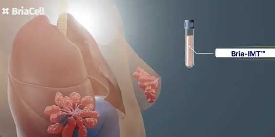 1名患者已存活近4年，1名患者脑转移完全消失！新型免疫疗法Bria-IMT为晚期乳腺癌带来希望