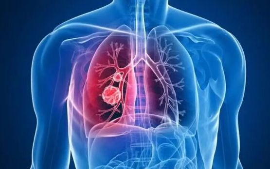 美国上市新药：针对晚期非小细胞肺癌，FDA授予创新药KB707“超级绿通”认定