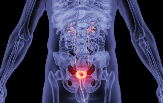 美国上市新药：晚期尿路上皮癌新药AKY-1189获快速通道资格，独特作用机制精准杀死癌细胞！