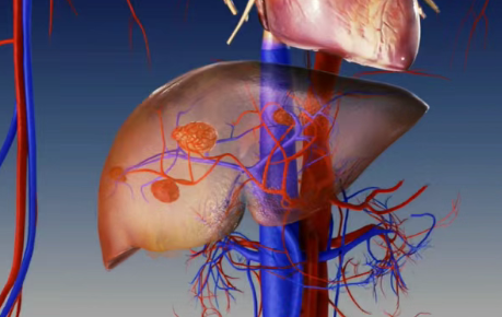 92%肝癌患者肿瘤完全消失!SIR-Spheres Y-90疗法带来“震撼”数据