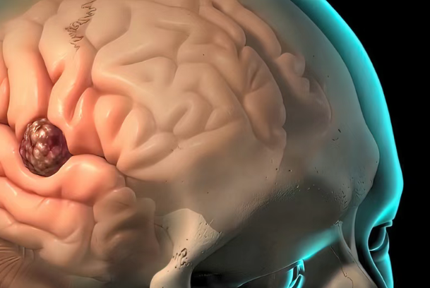 胶质母细胞瘤新突破！美国加州大学旧金山分校专家绕过血脑屏障，带来治疗新突破