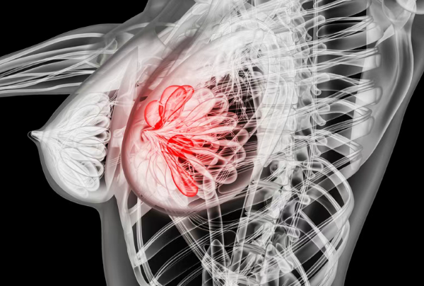 科学家开发出新型检测工具，能有效预测乳腺癌10年复发风险，还能判断是否需要放疗