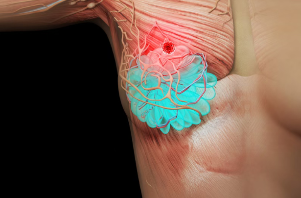 美国医学前沿:晚期乳腺癌新药Gedatolisib有望年内上市