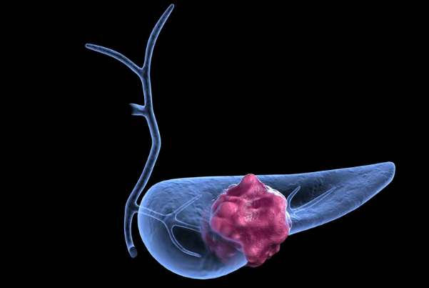 晚期胰腺癌新希望:新药VCN-01疗效获认可,将开展3期关键临床试验