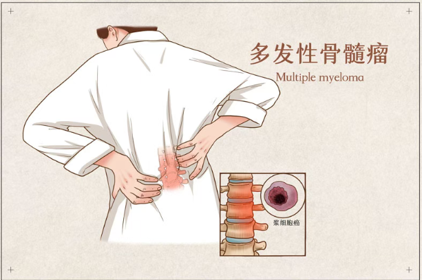 多发性骨髓瘤新疗法Tec-Dara在美国获批，疾病进展或死亡风险降低83%！