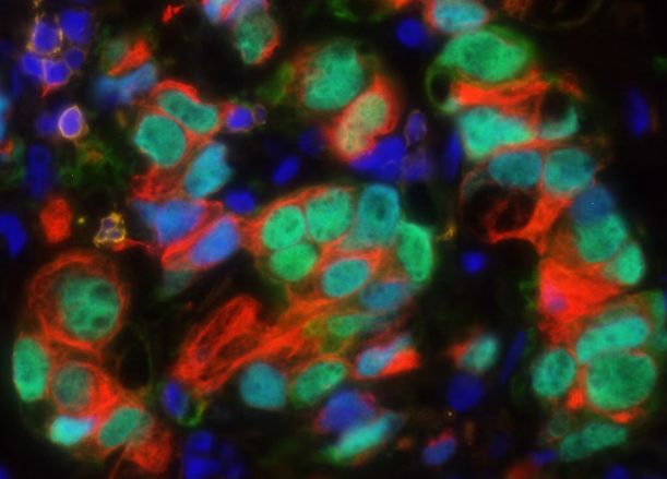 83%晚期前列腺癌患者病情得到控制，英国皇家马斯登医院公布新药225Ac-PSMA-Trillium疗效显著