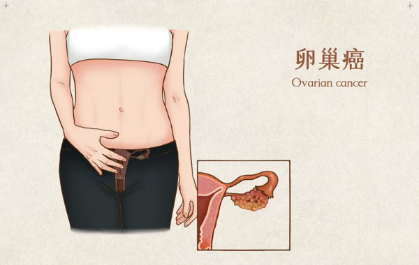 29%患者5年未进展！PARP抑制剂Rubraca为晚期卵巢癌带来长期控制希望