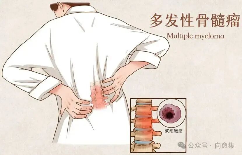 美国FDA重磅批准！复发性骨髓瘤迎来治疗新拐点，3年无进展率超8成！