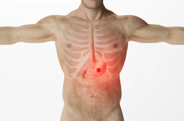 75%患者肿瘤明显缩小或消失!美国胃癌新药Givastomig疗效亮眼,有望加速上市