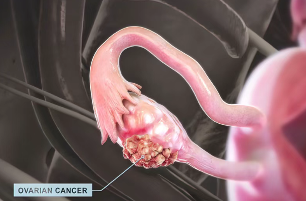 平均生存期延长12个月！美国新药Elenagen联合化疗，为铂类耐药卵巢癌患者带来新希望