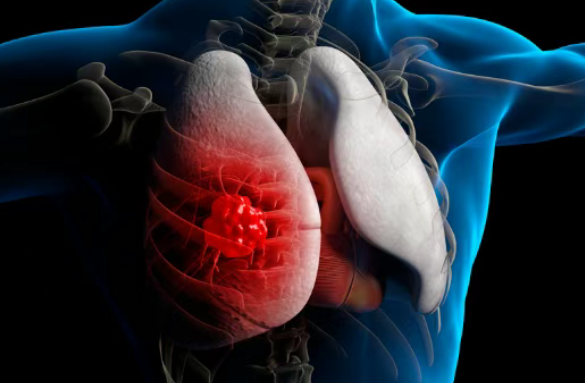 MD安德森专家权威解读：晚期小细胞肺癌迎来“维持治疗”新时代！