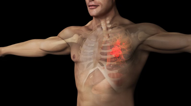 87%患者肿瘤明显缩小或消失，96%患者病情得到控制！美国新药Calderasib治疗晚期肺癌效果炸裂！