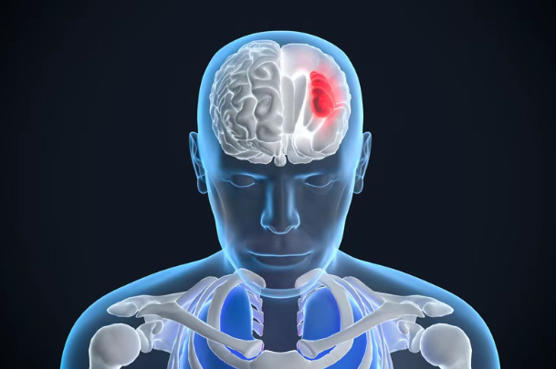 美国新药SRN-101获批启动1期临床试验,复发性高级别胶质瘤迎来新希望