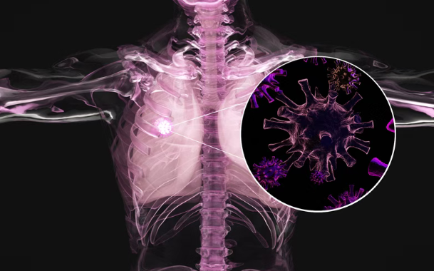 欧洲肺癌大会：免疫治疗新药Gotistobart让晚期肺癌患者活得更久，死亡风险降低54%！