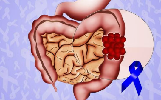 86.3%患者3年未复发！这种结肠癌新方案，将复发或死亡风险降低一半