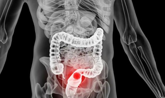 87%患者病情得到控制！美国新药Ozekibart联合化疗为晚期结直肠癌患者带来新希望