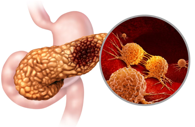 新型抗癌药RM-055公布重磅数据：对胰腺癌、肺癌、肠癌都有效，耐药也能逆转！