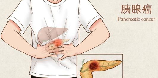 美国新药elraglusib不杀癌细胞，却能让化疗如虎添翼！转移性胰腺癌1年生存率翻倍！