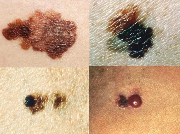 无药可治晚期黑色素瘤患者案例：美国希望之城City of Hope通过TIL疗法让他的肿瘤完全消失！