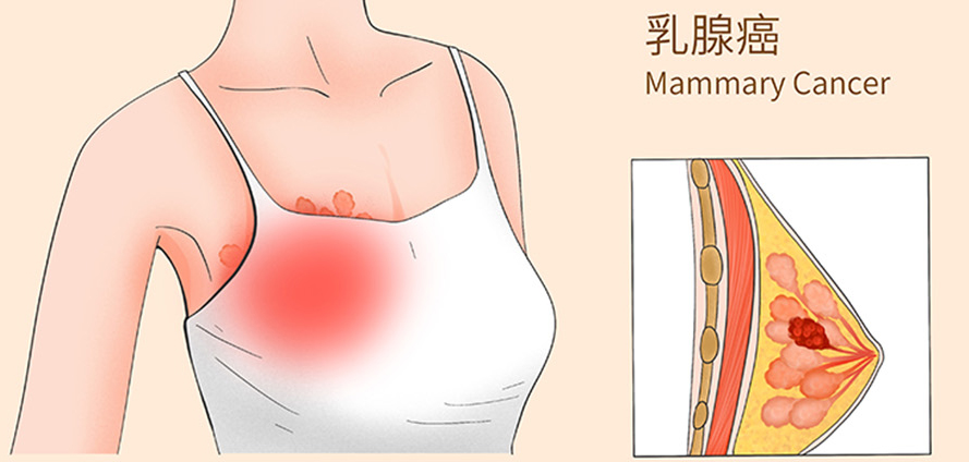 美国FDA批准三阴性乳腺癌首款一线ADC药物Datroway!疗效优于化疗、生存期显著延长!