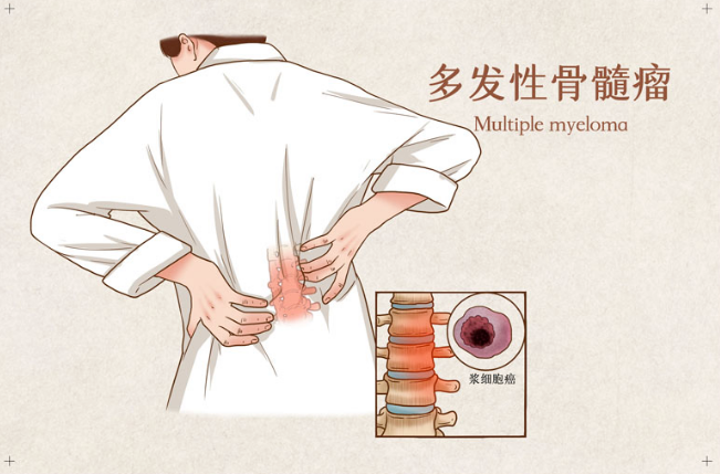 美国制药巨头：复发/难治性骨髓瘤新药elranatamab-bcmm肿瘤控制时间显著延长！