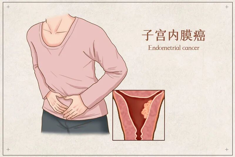 2026年ASCO年会：晚期或复发子宫内膜癌也能治愈！多塔利单抗联合化疗方案带来新可能！