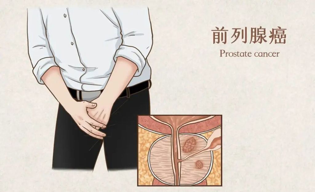 盛诺一家推出【前列腺癌多学科治疗策略评估项目】，帮助患者告别治疗困境