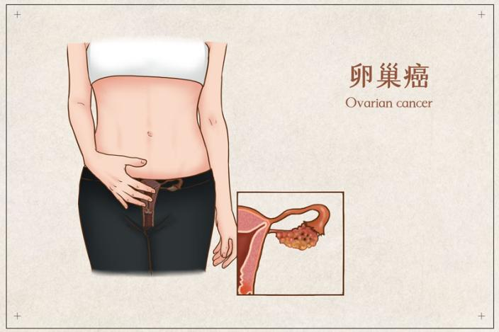 卵巢癌治疗陷入僵局，她赴英就医后迎来转机：肿瘤标志物下降一半，肿瘤逐渐缩小…