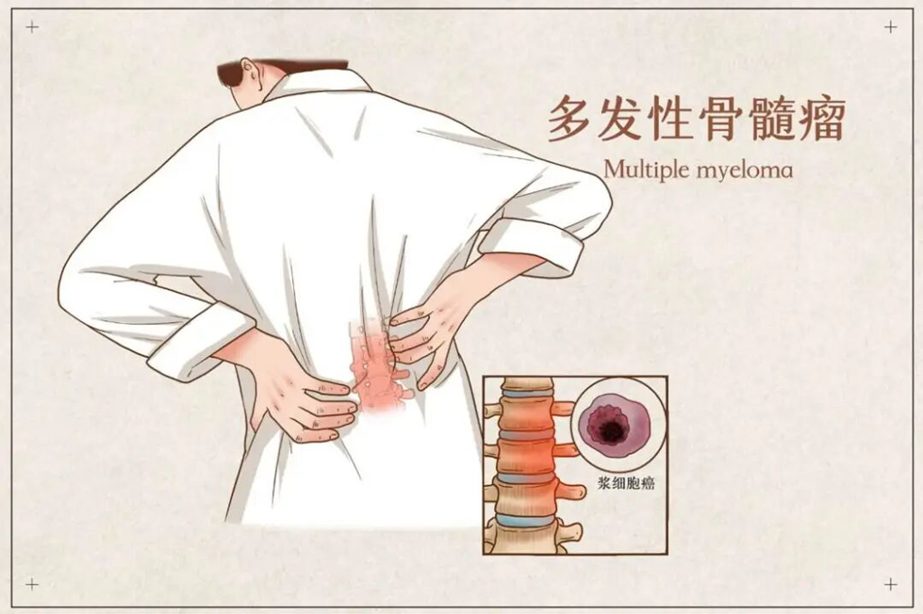 欧盟批准特立妥单抗Tecvayli联合新疗法：超80%多发性骨髓瘤患者三年病情无进展