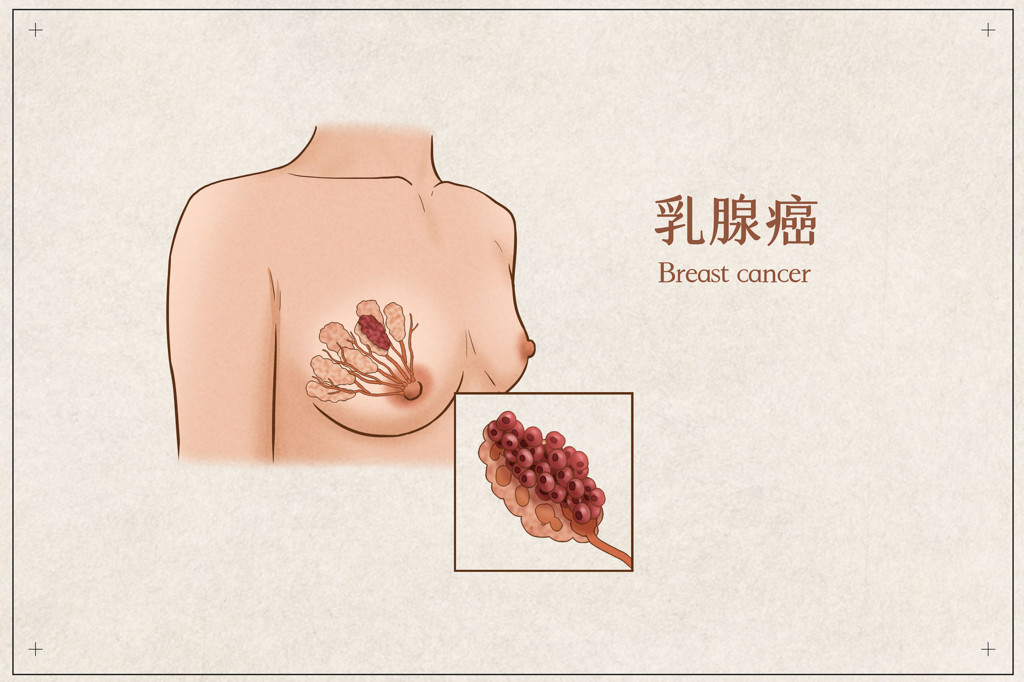 乳腺癌赴美就医怎么选医院？2026美国癌症Top5医院全部签约盛诺一家
